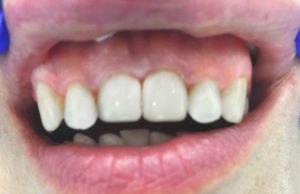 Замена старых винилов на зубах 1.1 и 2.1. Материал Estelite asteria ( Tokuyama Dental Corp.) Япония.