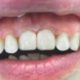 Замена старых винилов на зубах 1.1 и 2.1. Материал Estelite asteria ( Tokuyama Dental Corp.) Япония.